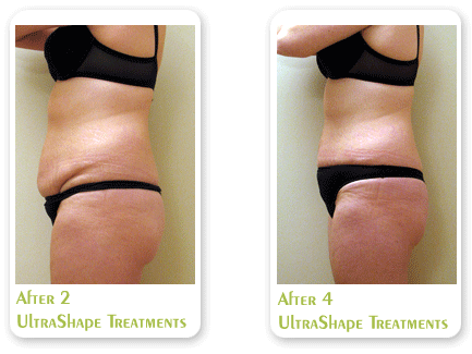 UltraShape Body Contouring - Before and after photo's